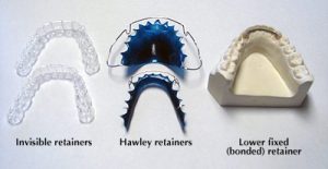 Retainers Miami FL