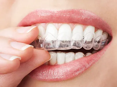 teeth with whitening tray